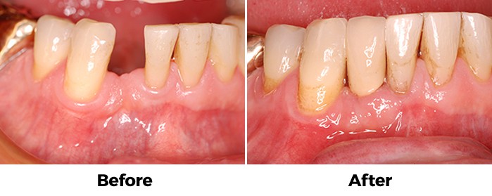 implant after and before