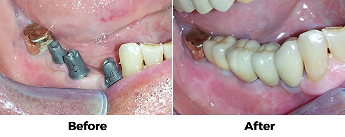 before and after implant