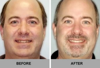 before and after invisalign near you