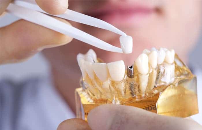 dental implants in yaletown