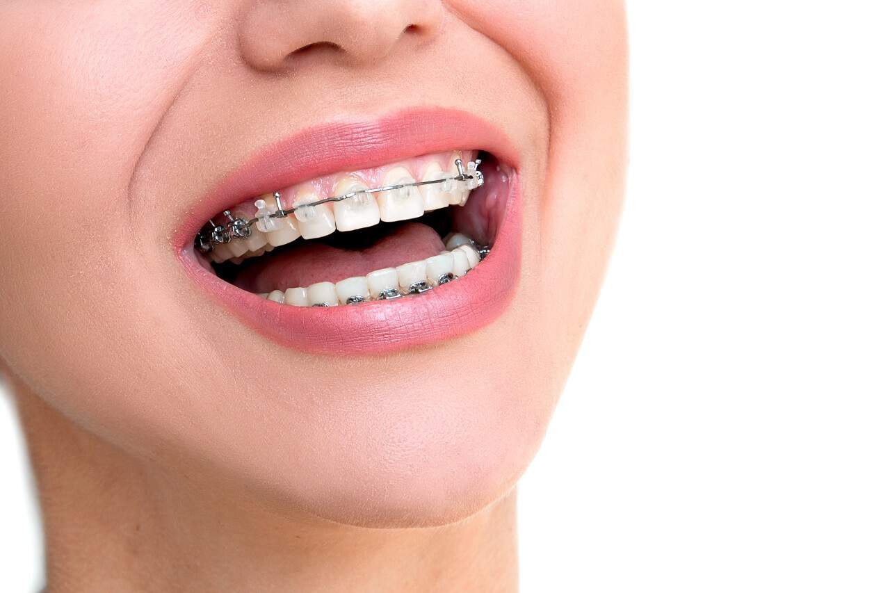 dental braces 5 foods you need to avoid today