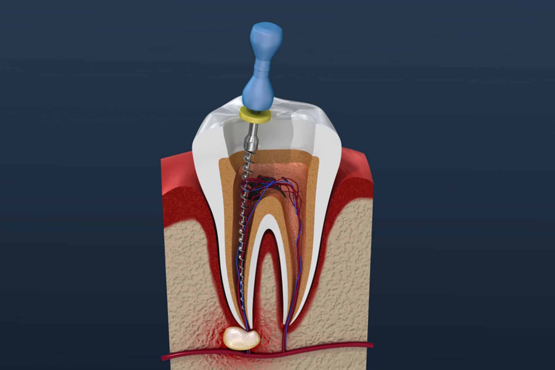 don’t be afraid of a root canal