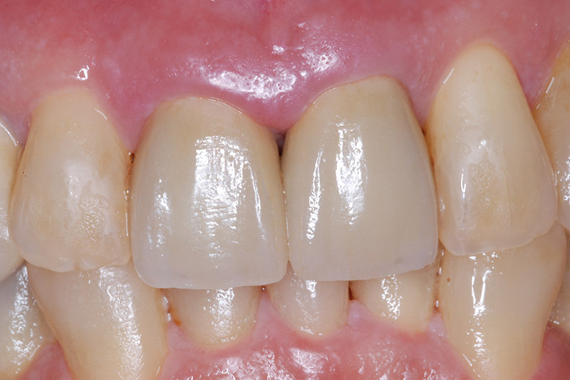 dental crowns dentist in yaletown