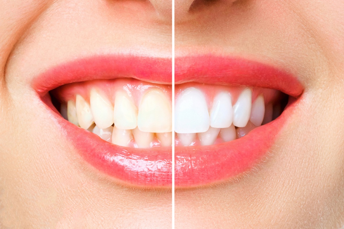 in office teeth whitening vs diy teeth whitening