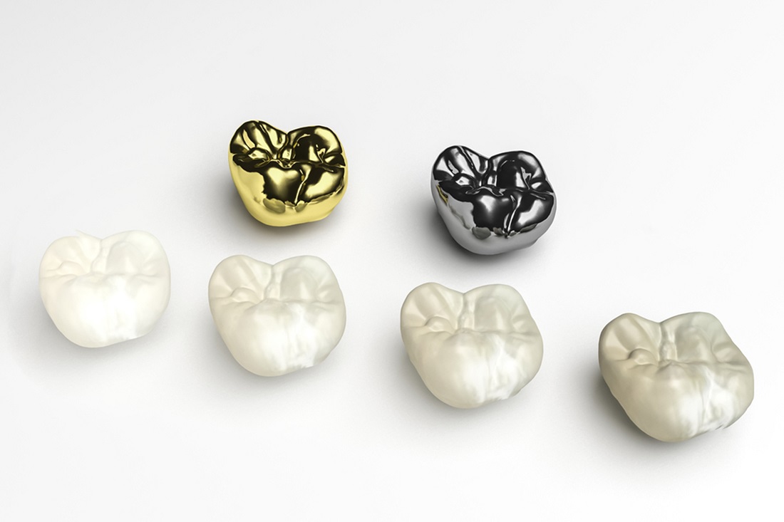 when is it time to replace your dental crown with a new one