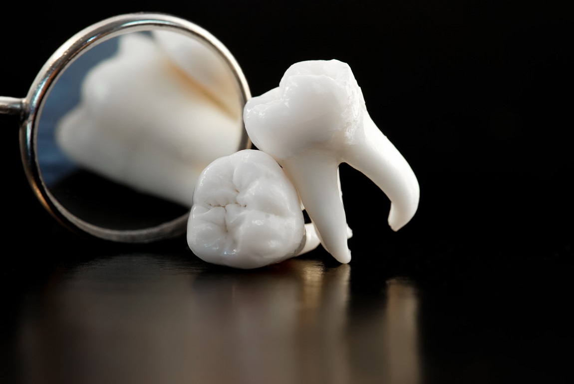 why and when to have your wisdom teeth pulled