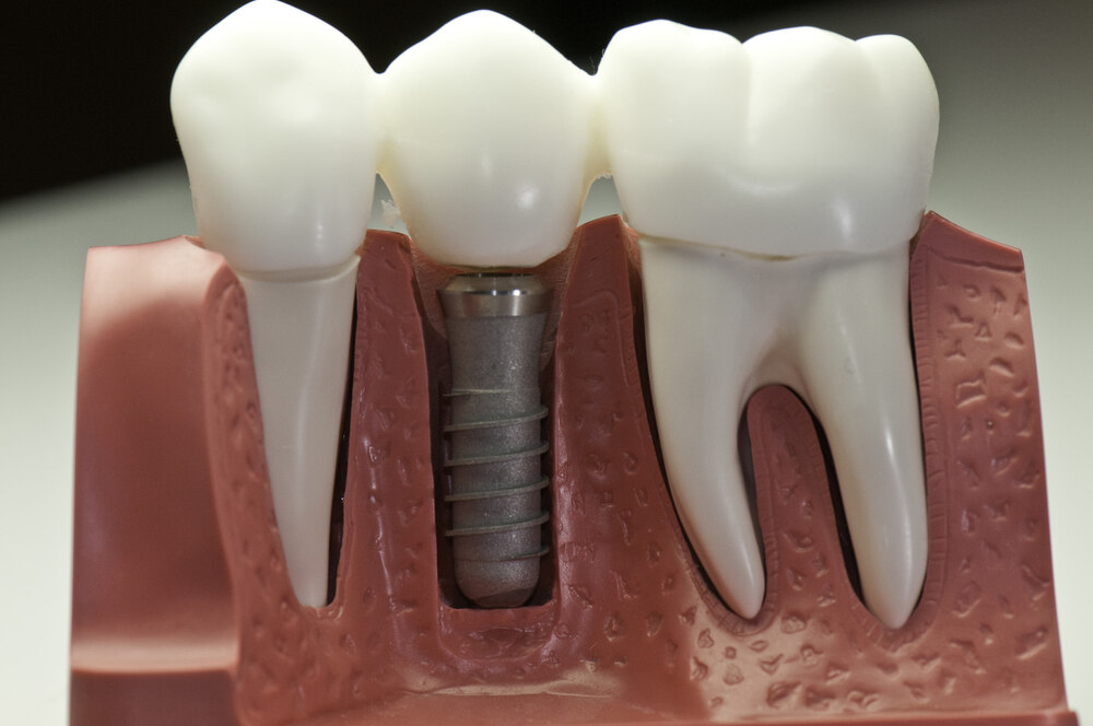 key facts about dental implants