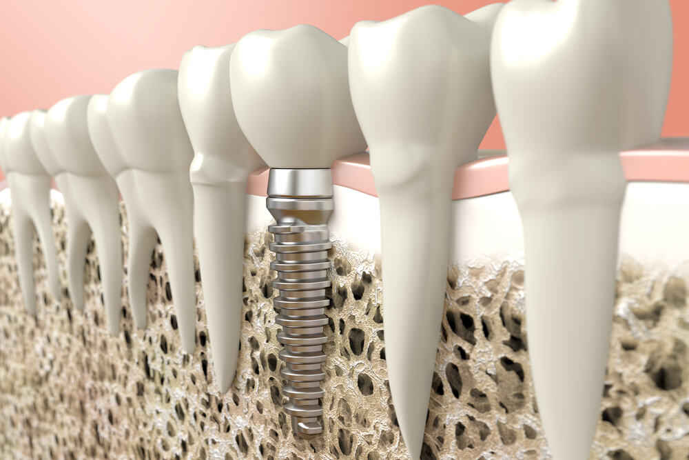 what is a recovery time for dental implants