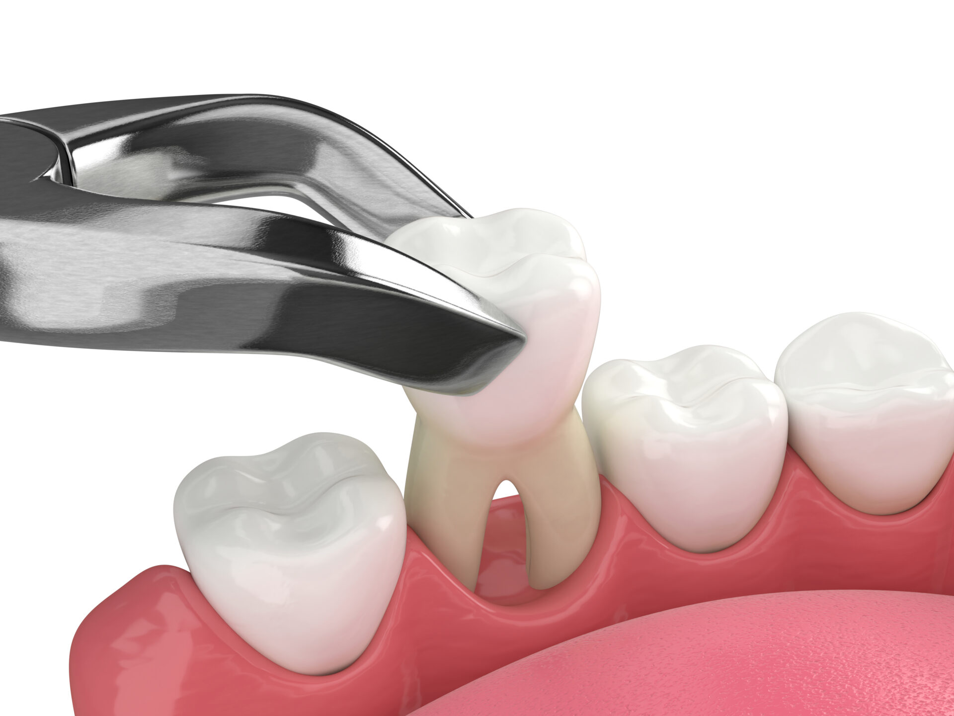 what are the stages of healing after a tooth extraction