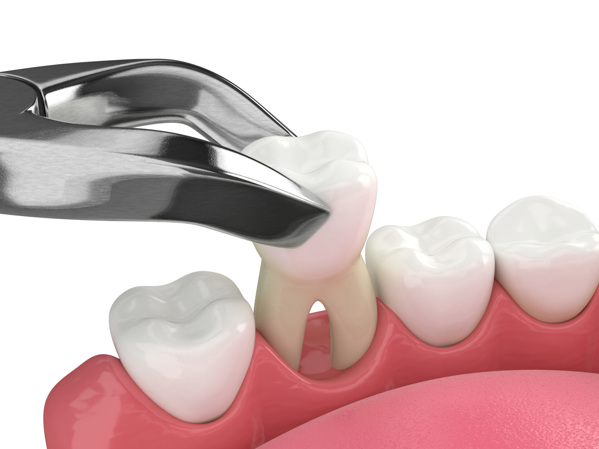 Is My Tooth Extraction Healing Properly