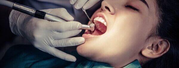 dental bonding for sensitive teeth
