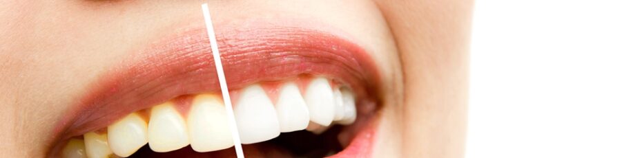 Teeth Whitening