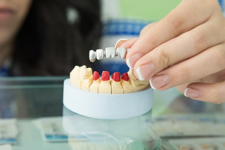what to expect during a dental bridges procedure
